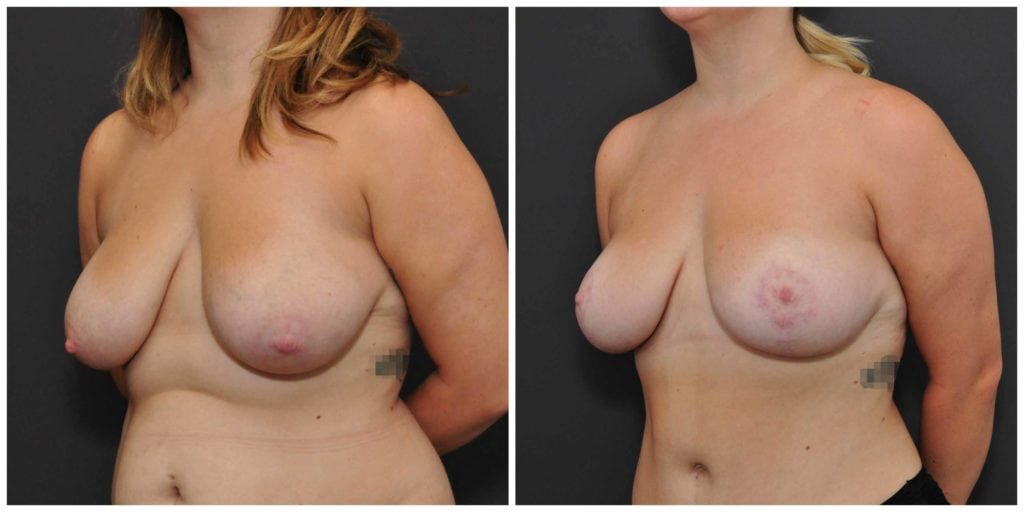 breast lift before and after san francisco