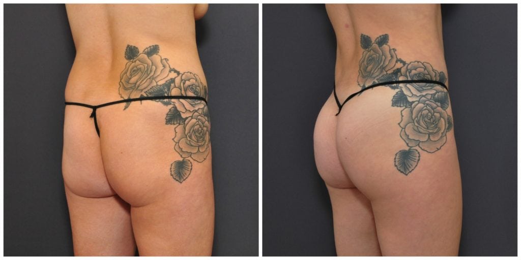 liposuction before and after san francisco