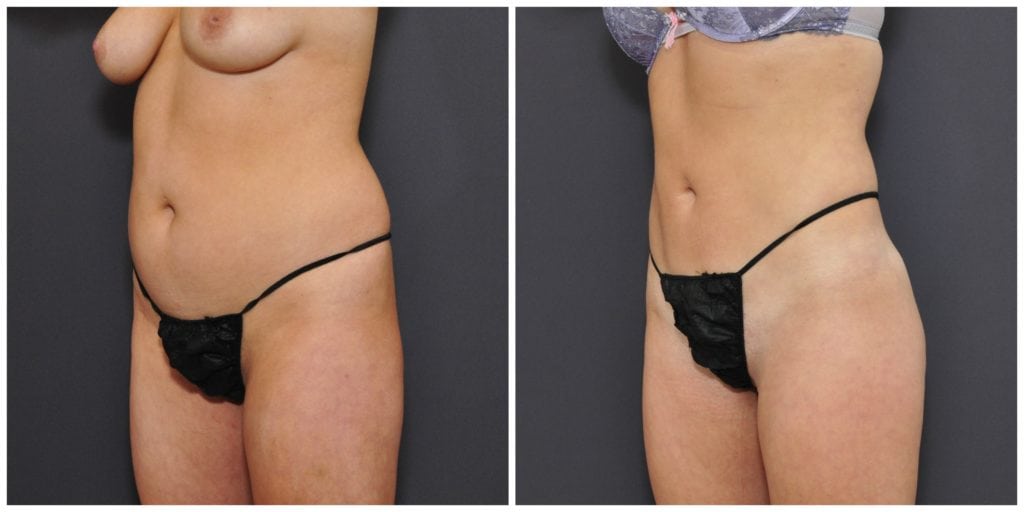 liposuction before and after san francisco