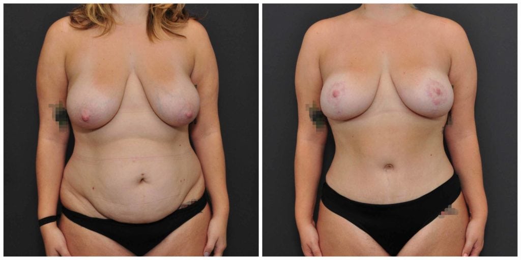 breast lift before and after san francisco