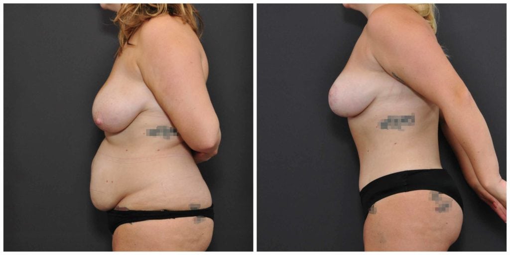 tummy tuck san francisco before and after