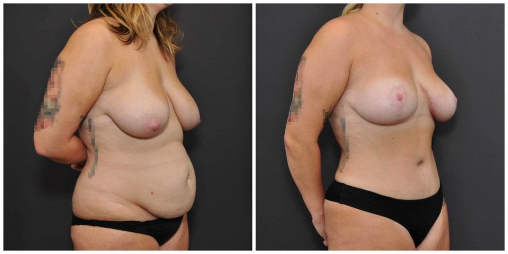 tummy tuck san francisco before and after