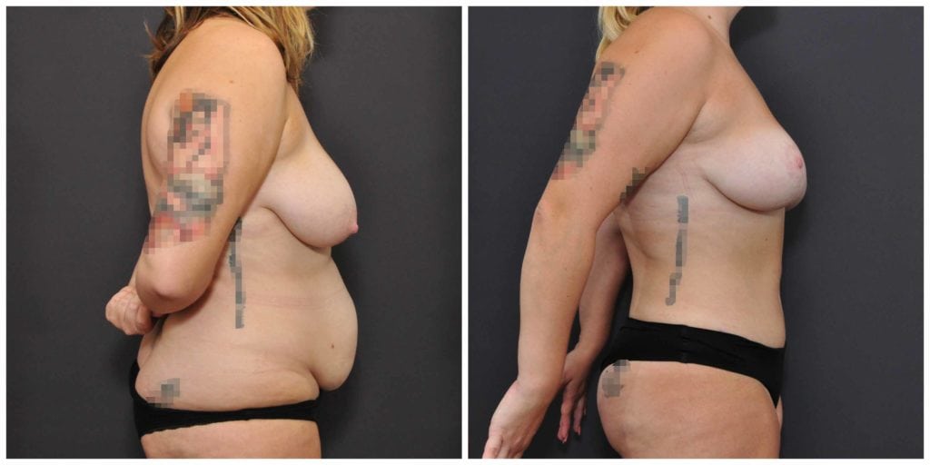 tummy tuck san francisco before and after