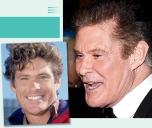 David Hasselhoff Plastic Surgery