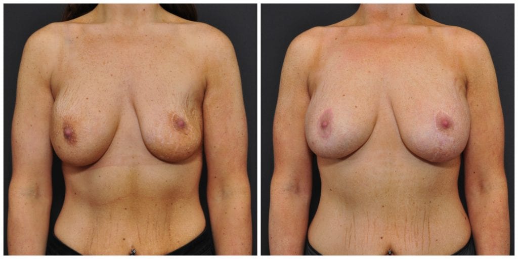 breast augmentation revision before and after bay area
