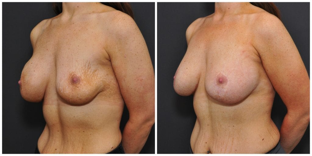 breast augmentation revision before and after bay area