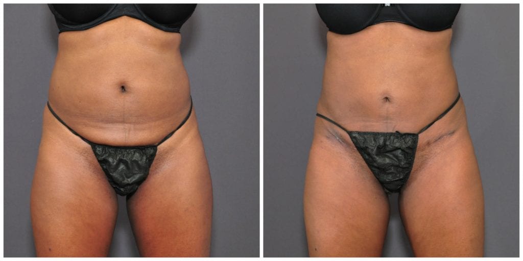 tummy tuck before and after san francisco