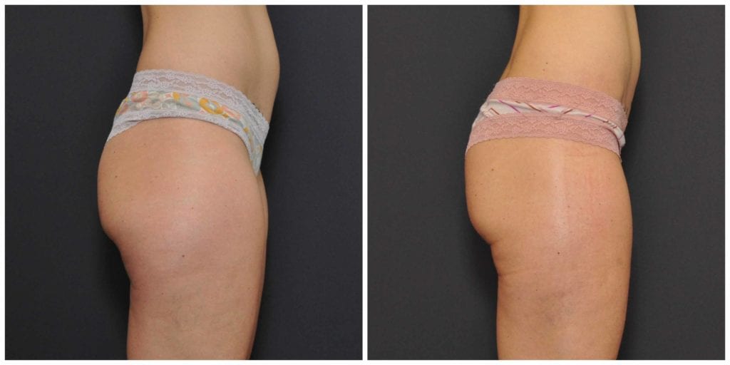 liposuction results bay area