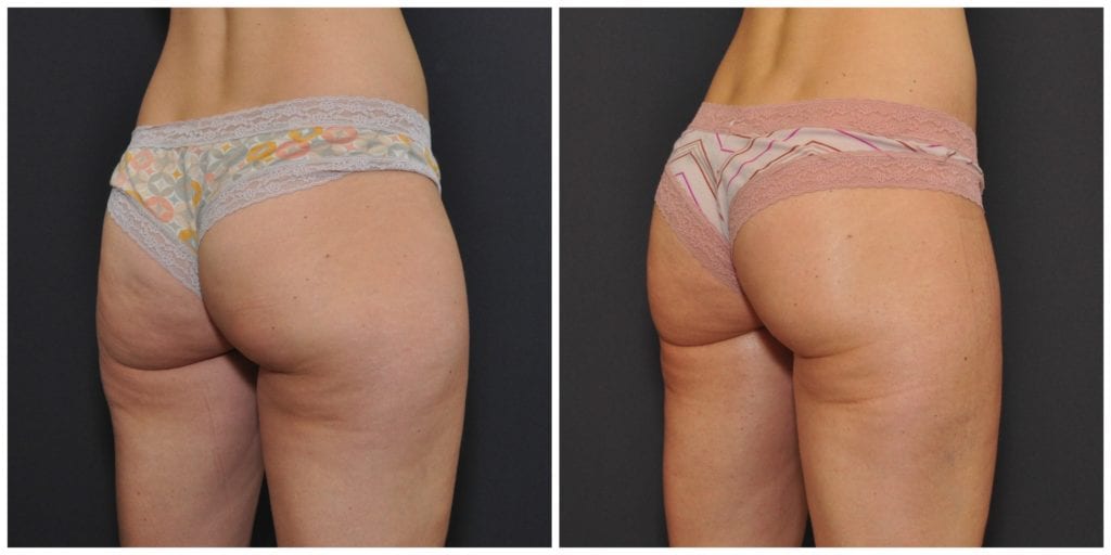 liposuction results bay area