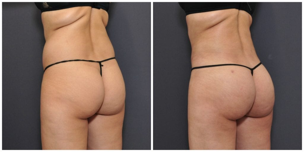 brazilian butt lift san francisco before and after