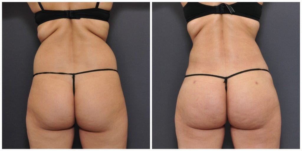 brazilian butt lift san francisco before and after