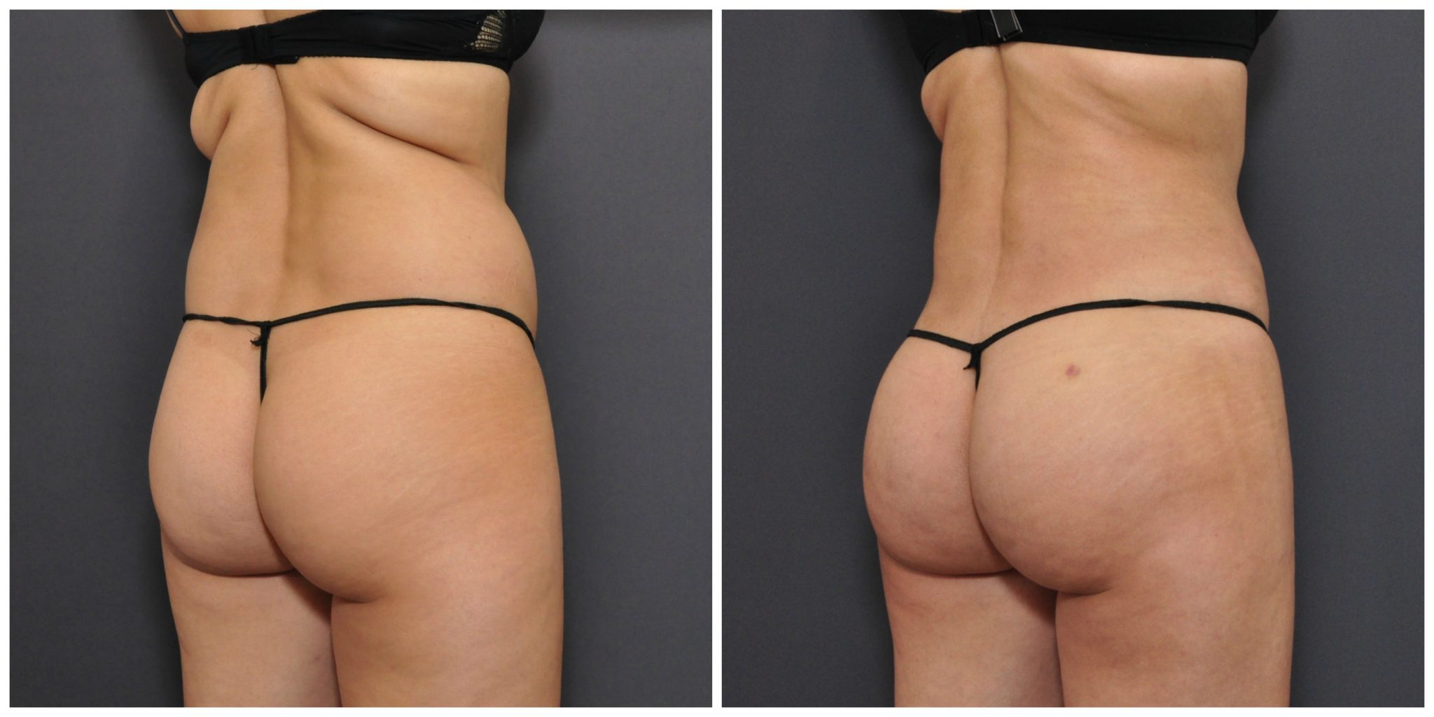 brazilian butt lift san francisco before and after