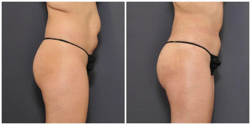 brazilian butt lift san francisco before and after
