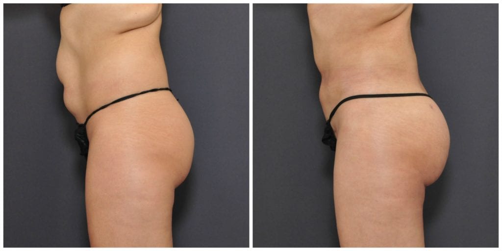 brazilian butt lift san francisco before and after