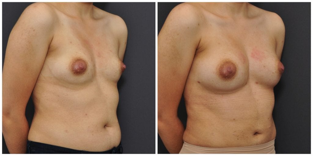 fat transfer san francisco results