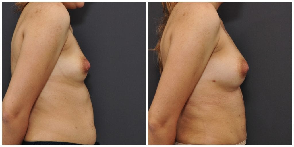 fat transfer san francisco results