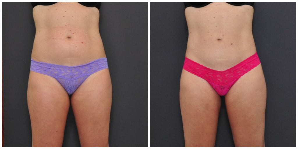 san francisco liposuction before and after