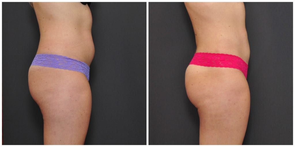 bay area liposuction before and after san francisco
