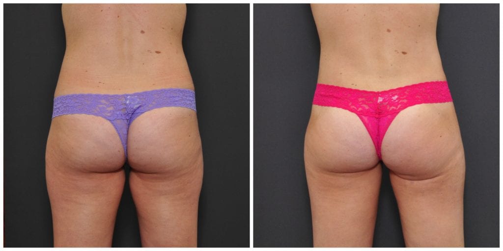 bay area liposuction before and after