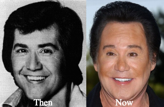 Wayne Newton Plastic Surgery