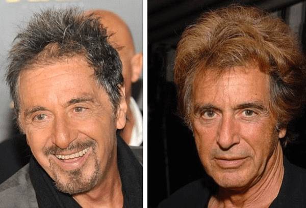 Al Pacino Plastic Surgery