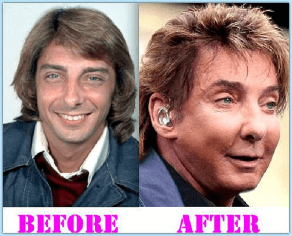 Barry Manilow Plastic Surgery