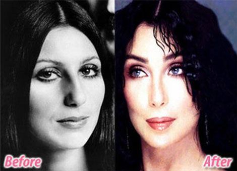 Cher Plastic Surgery