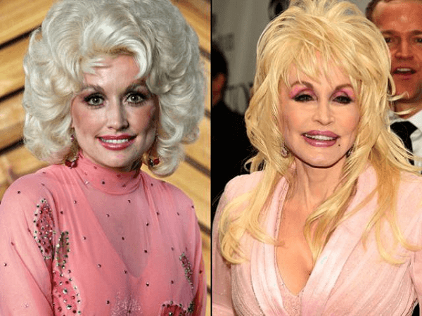 Dolly Parton Plastic Surgery 