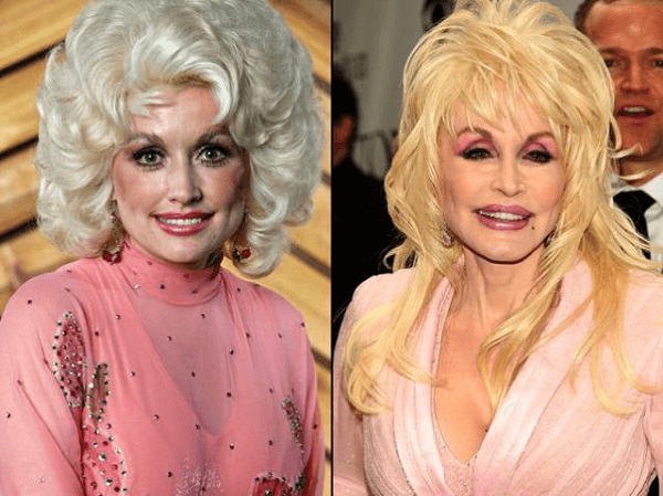 How Many Plastic Surgeries Has Dolly Parton Had