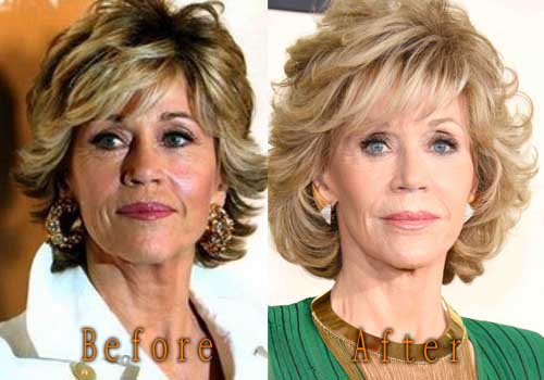 Jane Fonda Plastic Surgery