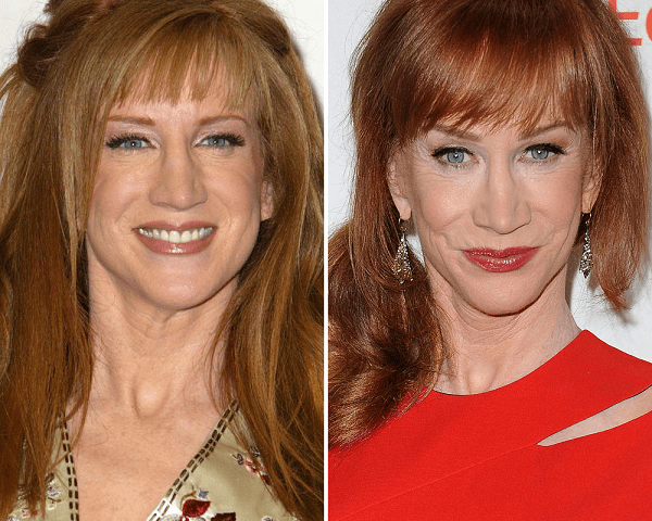 Kathy Griffin Plastic Surgery 