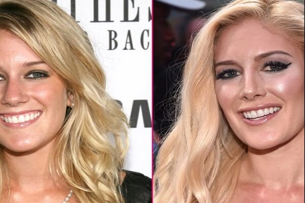 Heidi Montag Pratt Plastic Surgery