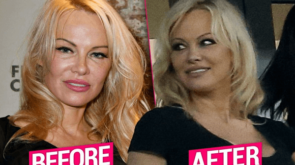 Pamela Anderson Plastic Surgery- celebrities with plastic surgery