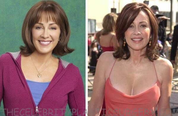 Patricia Heaton Plastic Surgery