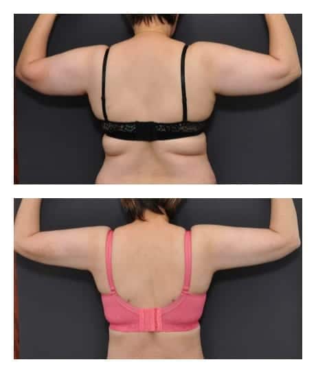 san francisco liposuction before and after