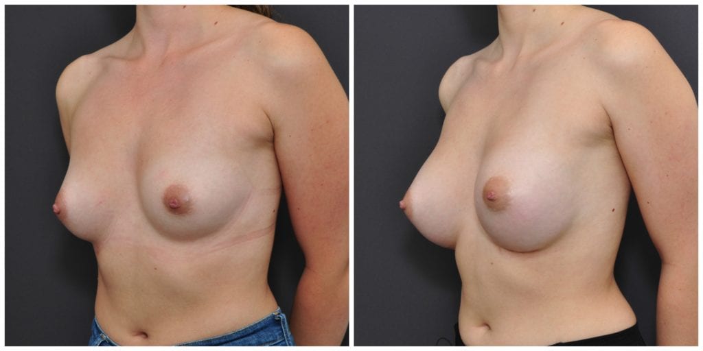Breast Augmentation Bay Area
