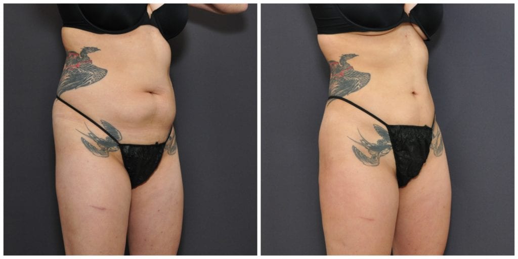 Liposuction San Francisco