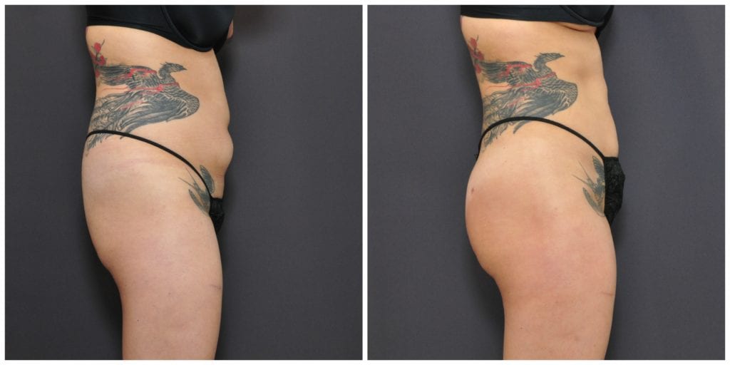 Liposuction San Francisco