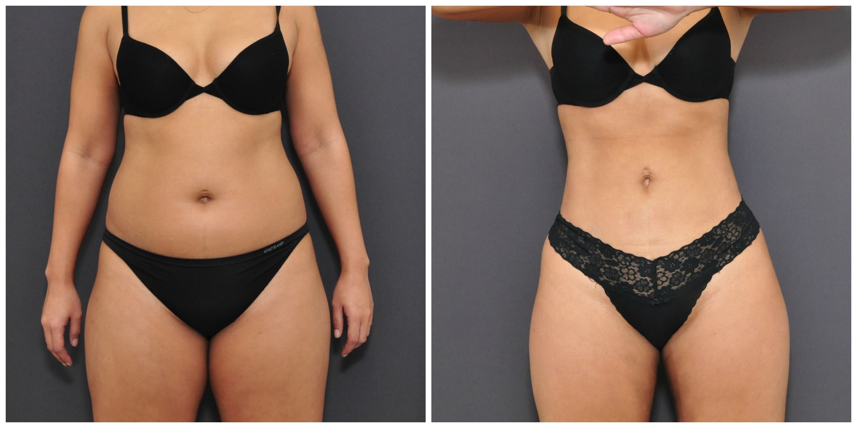 New York Liposuction