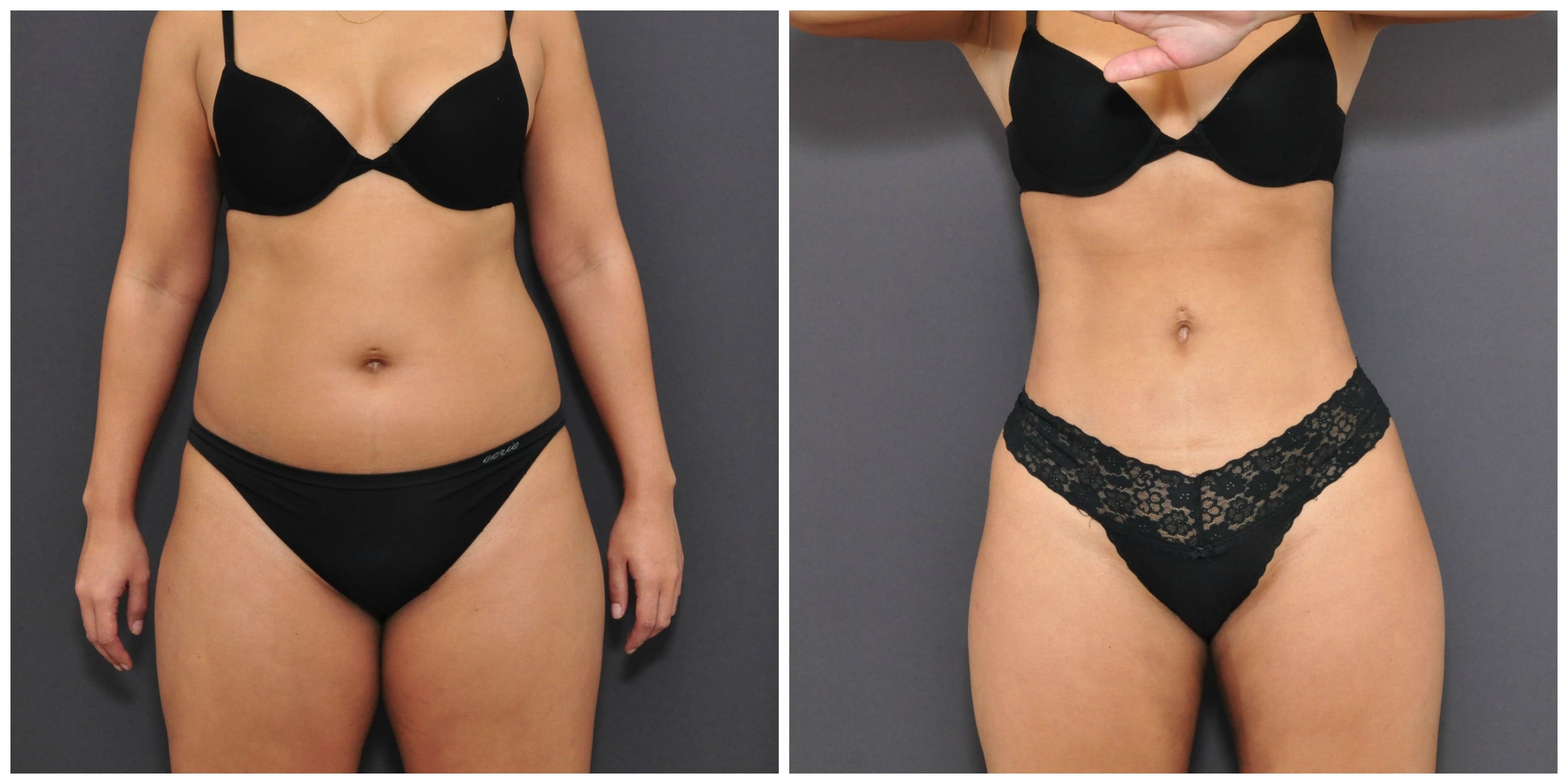 Liposuction New York