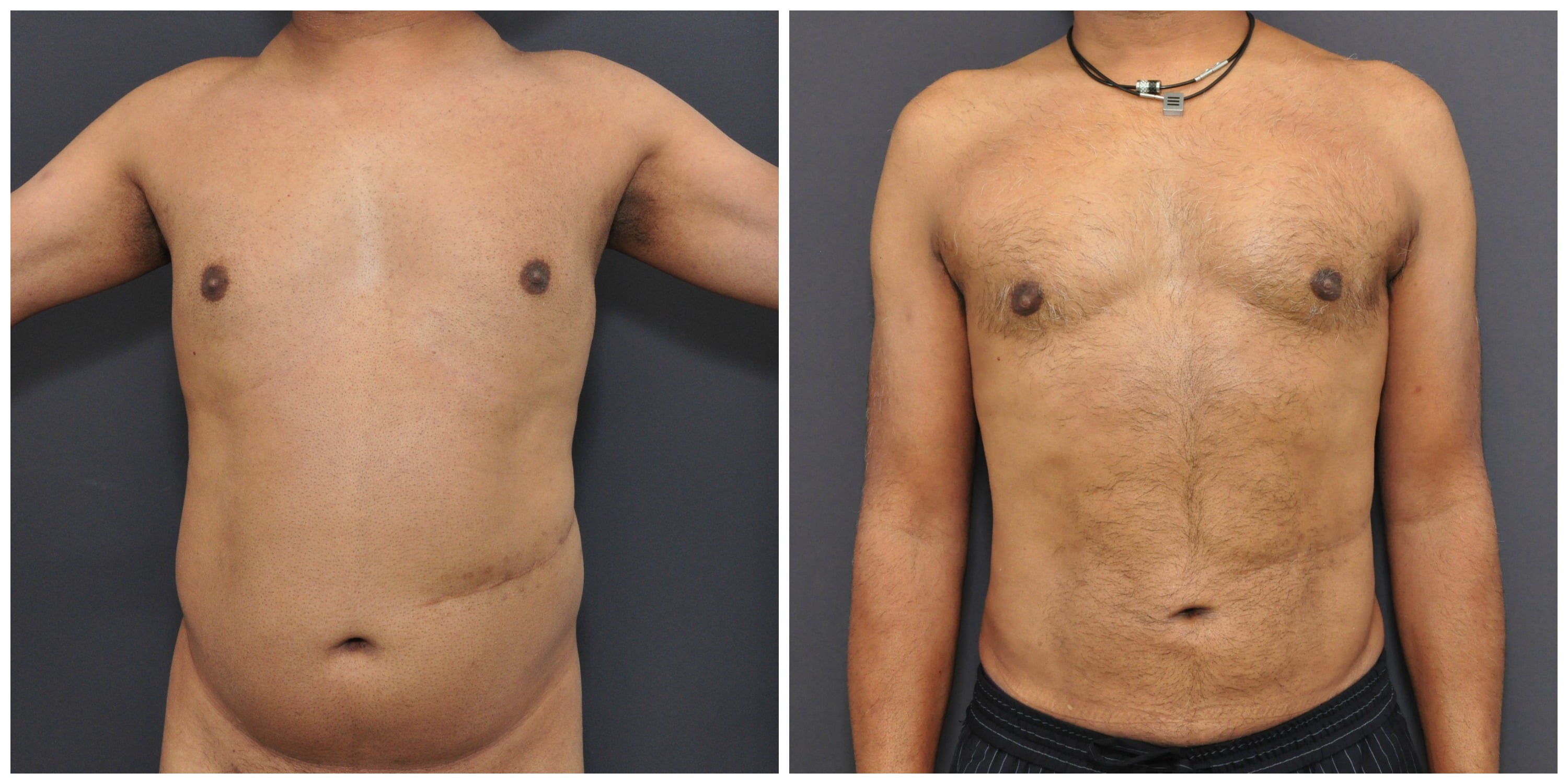 Liposuction Nyc