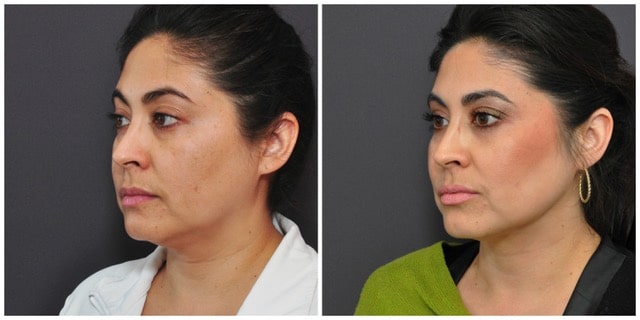 Best neck Liposuction San Francisco