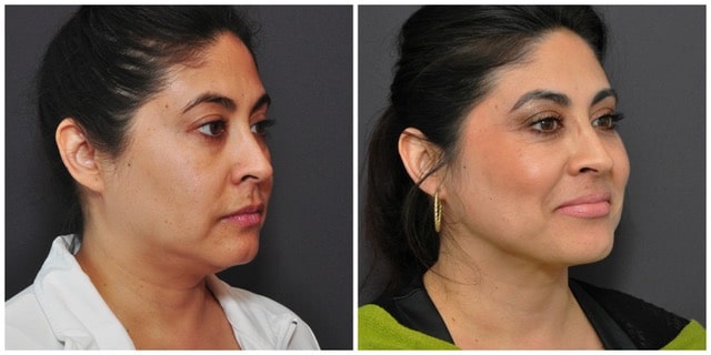 Neck Liposuction San Francisco right