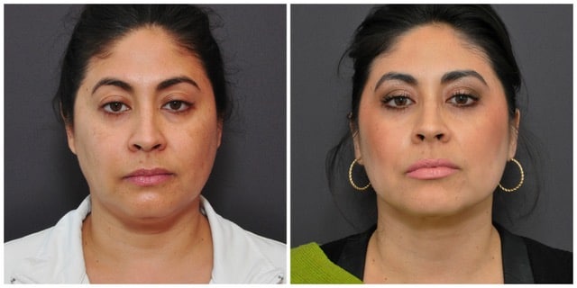 Neck Liposuction San Francisco