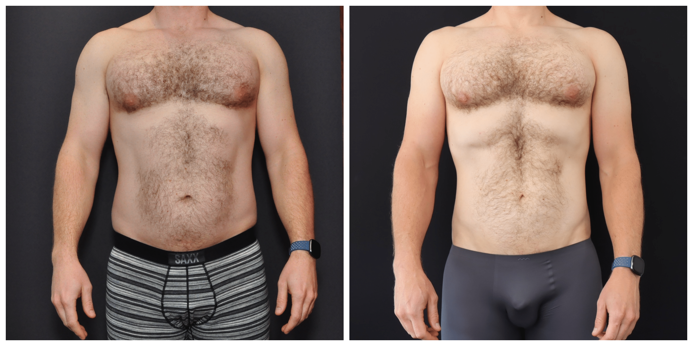 Liposuction of the abdomen and flanks, Plastic Surgeon San Francisco