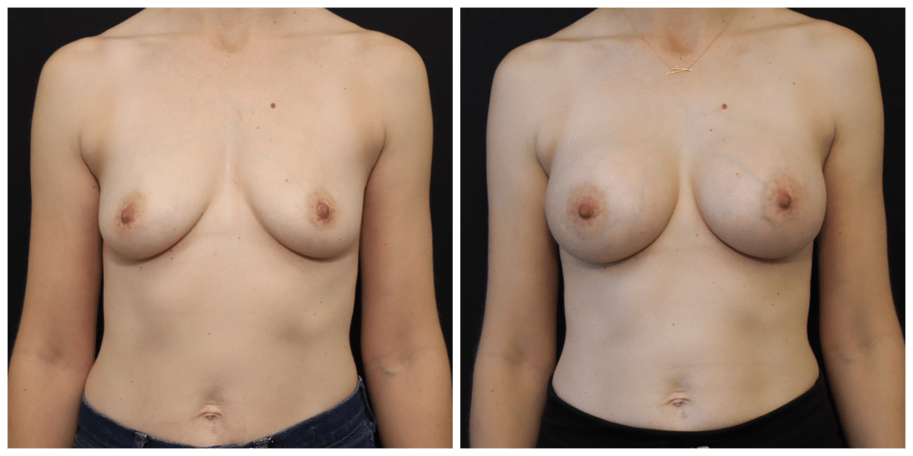 Breast Augmentation Before and After