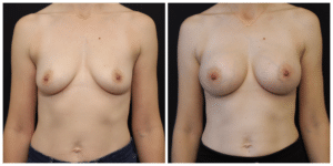 BREAST AUGMENTATION VS IMPLANTS