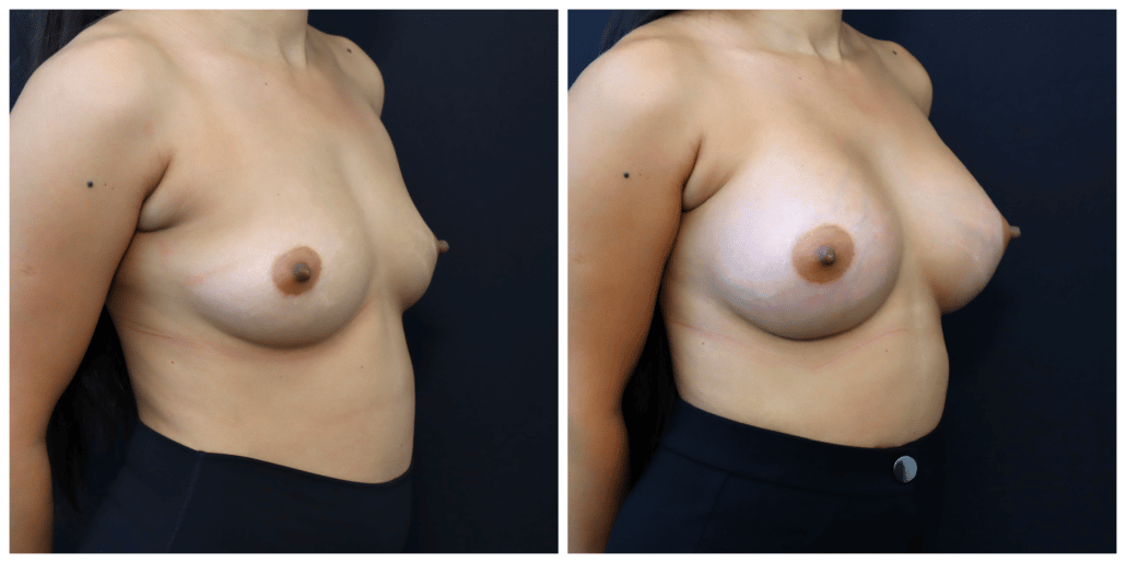 Breast Augmentation Before and After