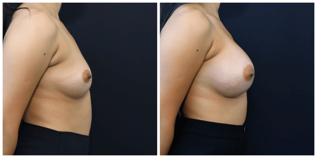 Breast Augmentation Before and After