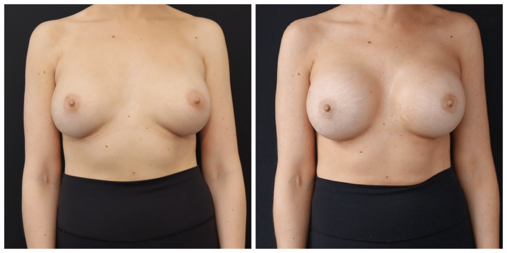 Breast Implant Revision Before and After
